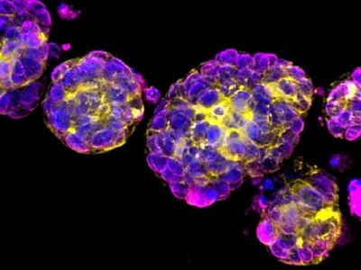 واکسن mRNAشخصی سازی شده برای درمان سرطان از راه رسید