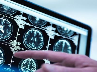 هوش مصنوعی چگونه می‌تواند به تشخیص علائم اولیه آلزایمر کمک کند